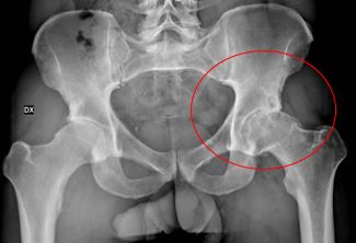 radiografia anca normale e artrosica