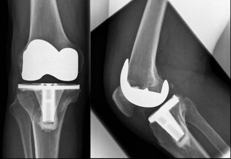 protesi del ginocchio-2