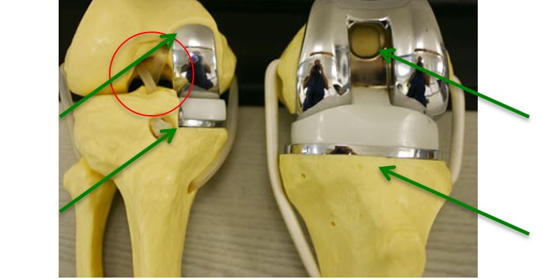 protesi monocompartimentale ginocchio
