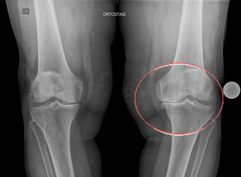 Artrosi ginocchio - Radiografia