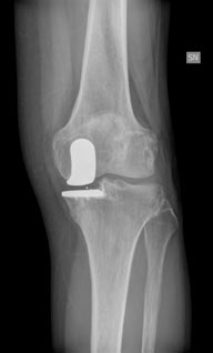 protesi del ginocchio 3