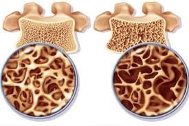 Osteoporosi