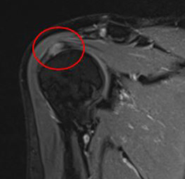 calcificazione tendinea visibile in risonanza